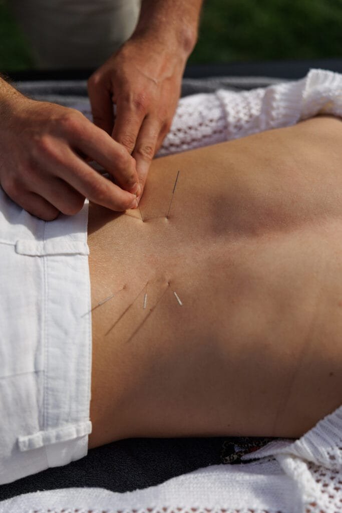 dry needling treatment in milos physiotherapy session