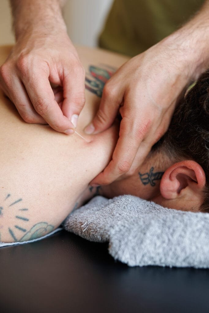 close-up of dry needle placement on neck muscle